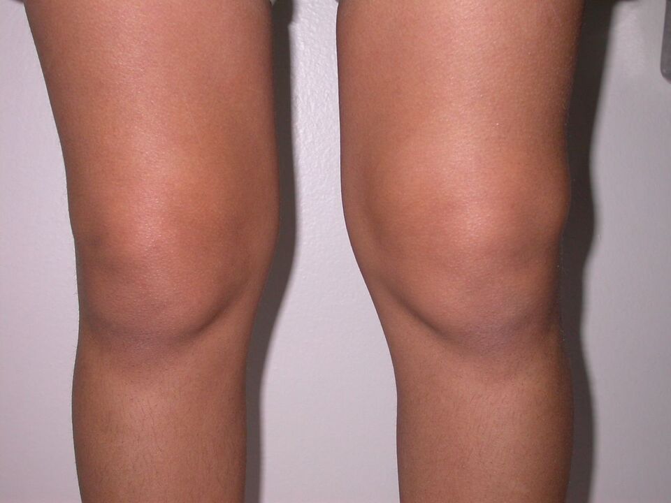 otok kolena v důsledku osteoartrózy