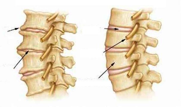 Co je to osteochondrosis