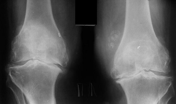X -Ray jako způsob diagnostiky artrózy kolenního kloubu