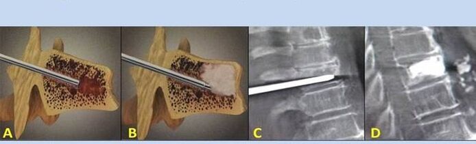 punkční vertebroplastika při bolestech zad