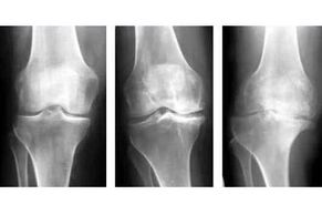 stadia artrózy kloubu na rentgenovém snímku