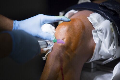 Injekce do kolenního kloubu pro artrózu