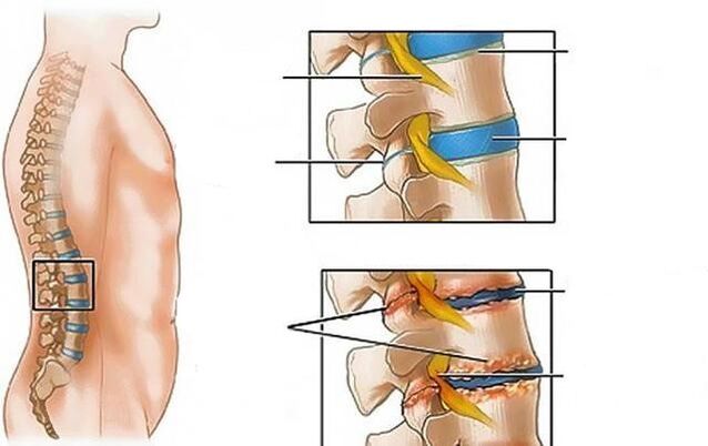 osteochondróza bederní páteře způsobuje bolesti zad